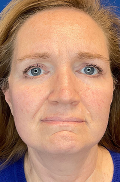 Real patient Facelift after photo