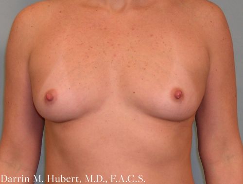Real patient Breast Augmentation before photo