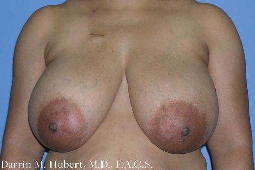 Real patient DIEP Flap Reconstruction before photo