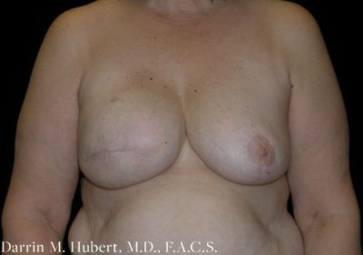 Breast Implant Reconstruction