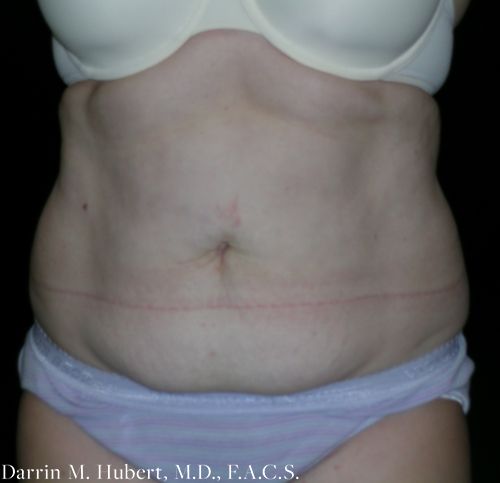 Real patient tummy tuck before photo