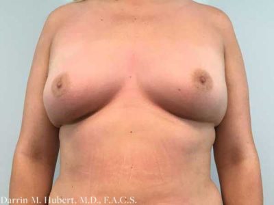 Breast Augmentation