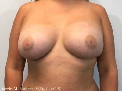 Breast Augmentation