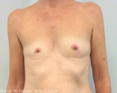 Breast Implant Reconstruction