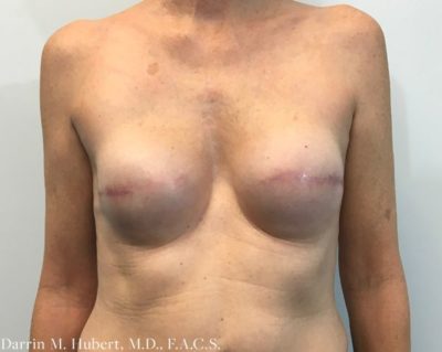 Breast Implant Reconstruction