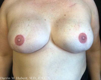 Breast Implant Reconstruction