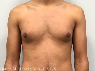 Gynecomastia