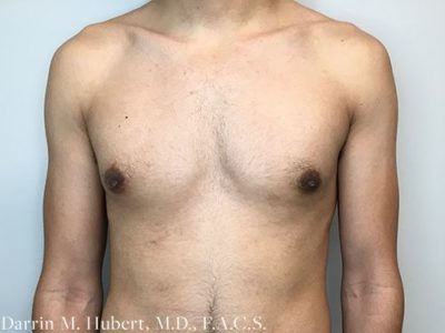 Gynecomastia