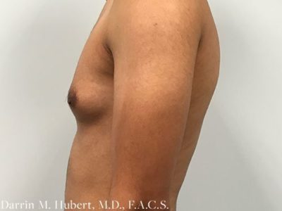 Gynecomastia