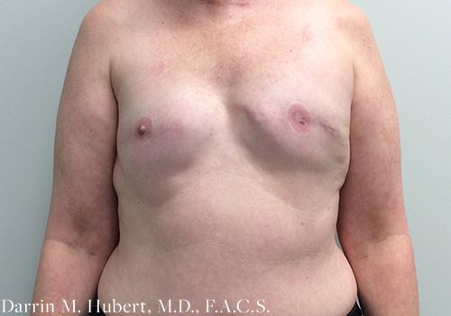 Real patient Breast Reconstruction before photo