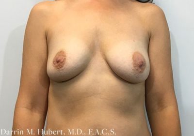 Breast Implant Reconstruction