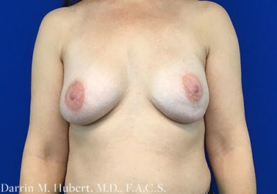 Breast Implant Reconstruction