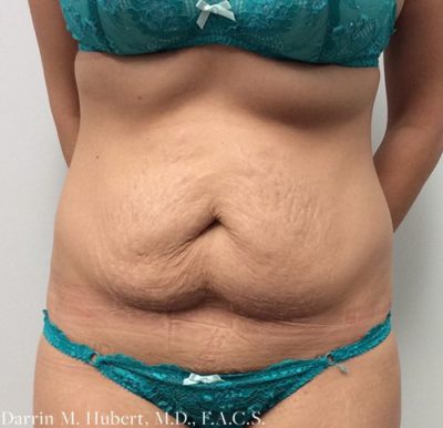 Tummy tuck