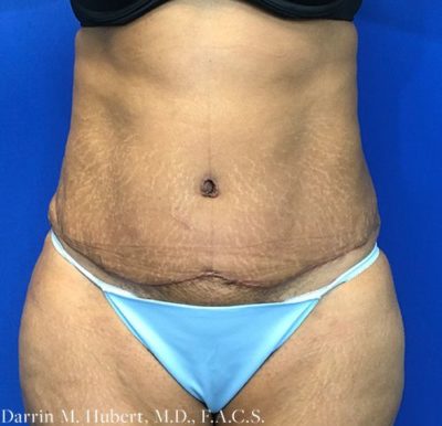 Tummy tuck