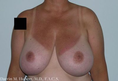 Breast Reduction