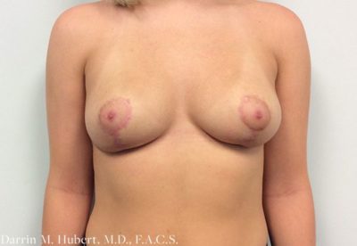 Real patient Breast Reconstruction after photo