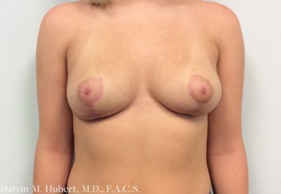 Breast Reduction