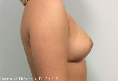 Breast Reduction