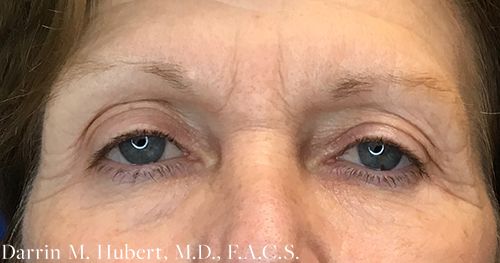 Real patient Eyelid before photo