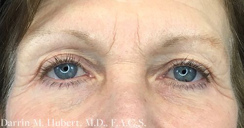 Real patient Eyelid after photo