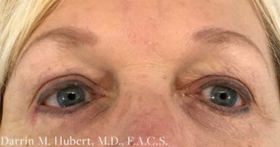 Eyelid Lift (Blepharoplasty)