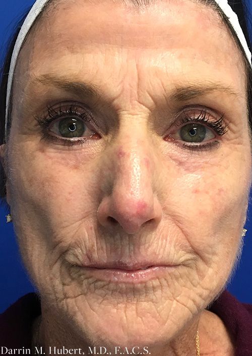 Real patient Laser and Skin Tightening before photo