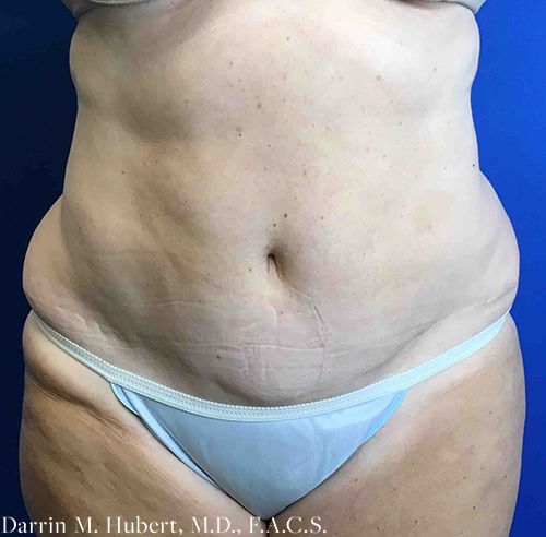 Real patient liposuction before photo