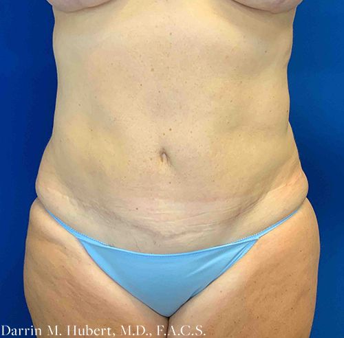 Real patient liposuction after photo