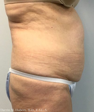 Tummy tuck