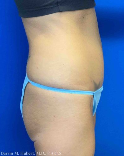 Tummy tuck