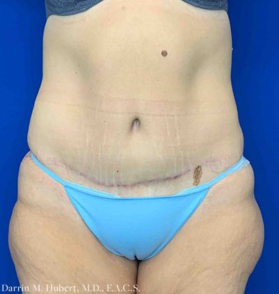 Tummy tuck