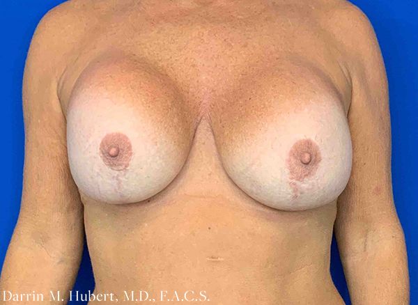 Real patient Breast Lift before photo