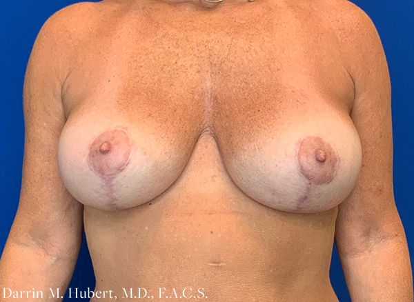 Real patient Breast Lift after photo