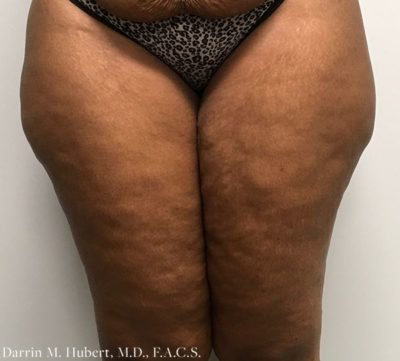 Liposuction