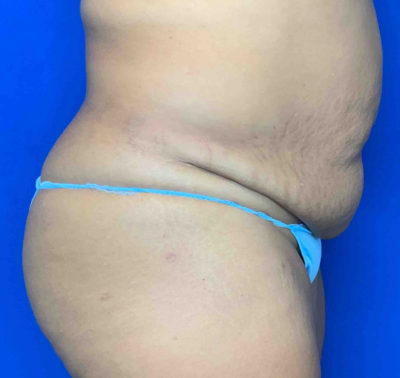 Tummy tuck