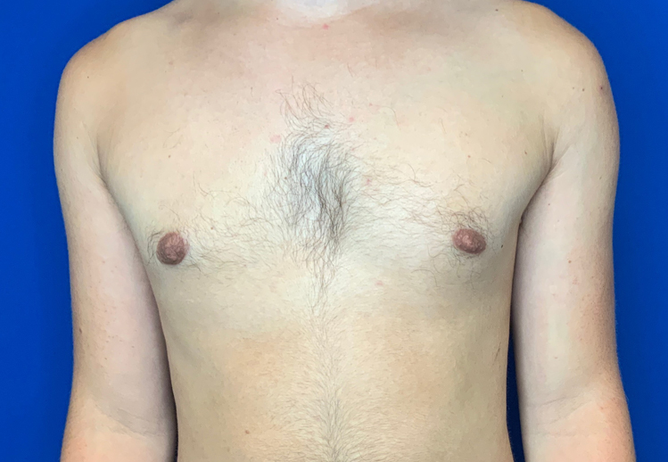 Real patient gynecomastia after photo