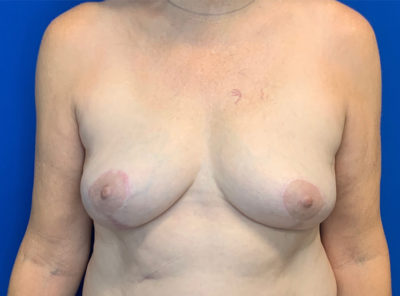 Breast Lift