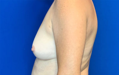 Breast Augmentation