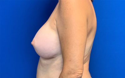 Breast Augmentation