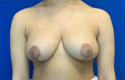 Breast Reduction