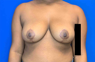 Breast Reduction