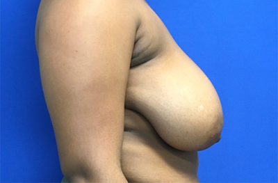 Breast Reduction