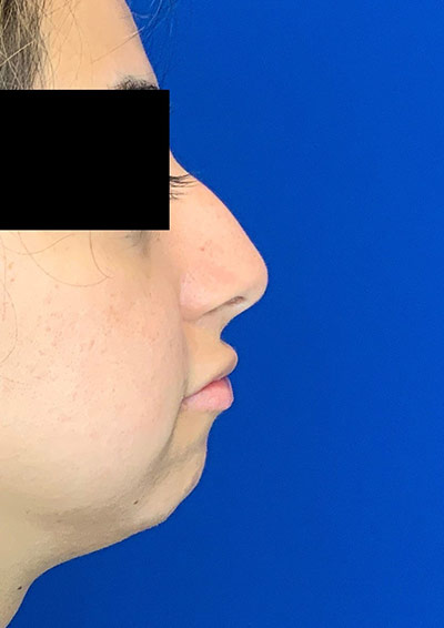 Rhinoplasty