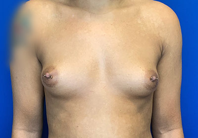 Breast Augmentation