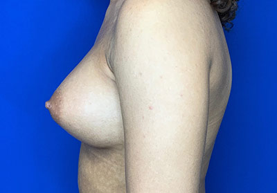 Breast Augmentation