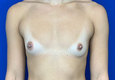 Breast Augmentation