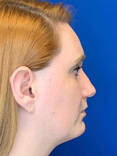 Real patient Rhinoplasty before photo