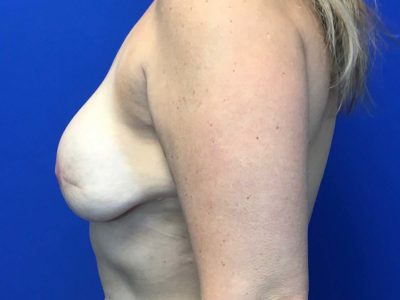 Breast Implant Reconstruction