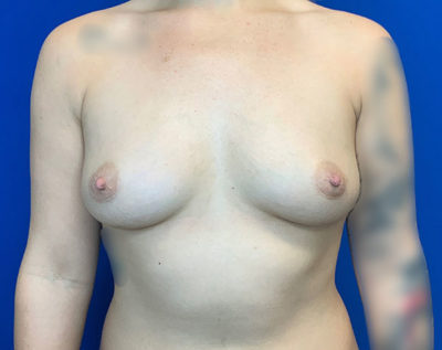 Breast Augmentation