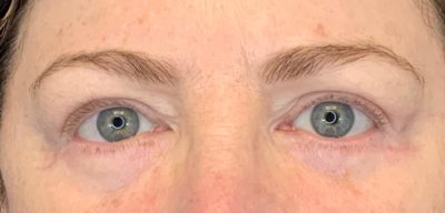 Eyelid Lift (Blepharoplasty)